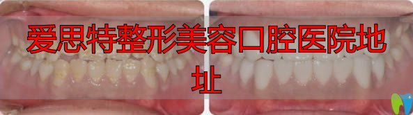 爱思特超薄瓷贴面修复案例及对比图