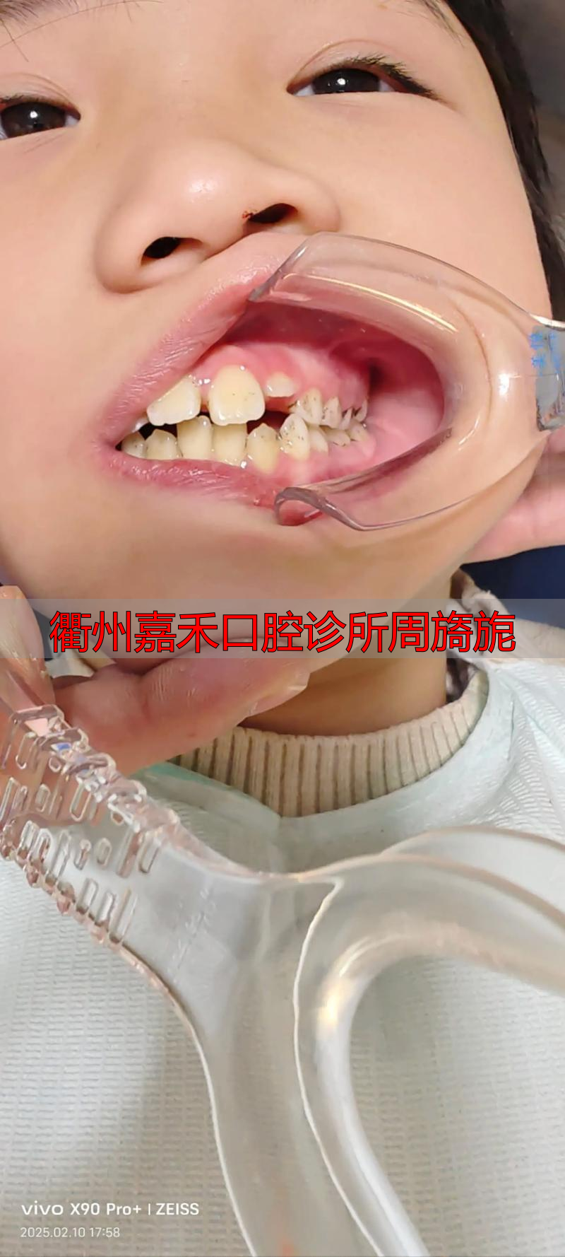 衢州嘉禾口腔周旖旎医生看儿童牙齿怎么样？专长早期矫治，孩子不害怕