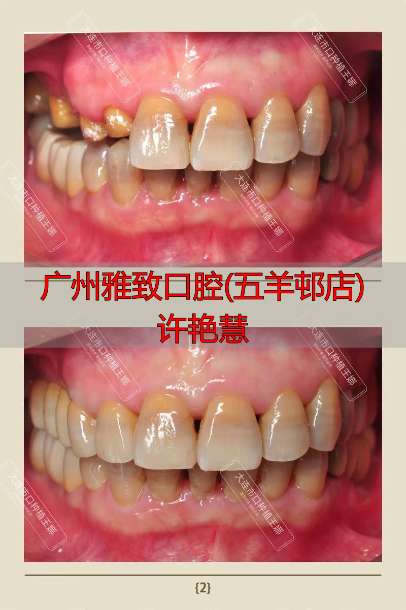 广州雅致口腔许艳慧医生怎么样？擅长种植牙和美学修复吗？
