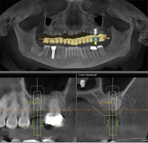梅州嘉诚口腔种植牙CT