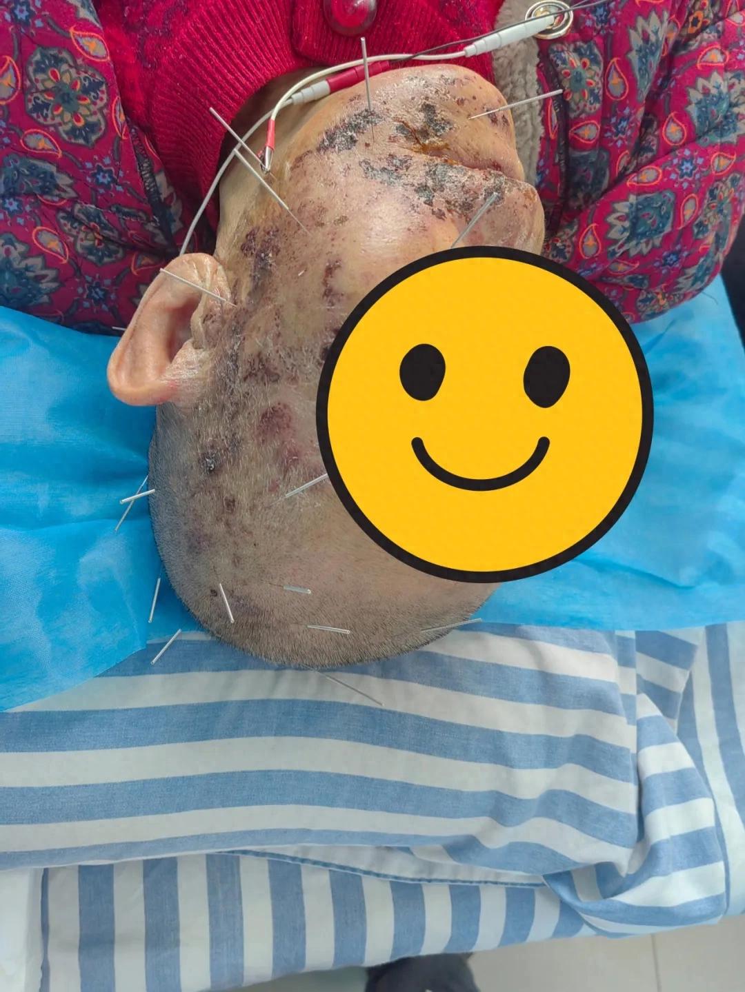 火针疗法缓解高龄患者神经痛_张掖市中医医院针灸科火针治疗三叉神经带状疱疹_张掖口腔医院排名