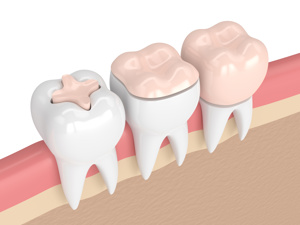 今日关注！武汉专业种植牙医院“精彩发布”瑞士ITI种植牙价格多少
