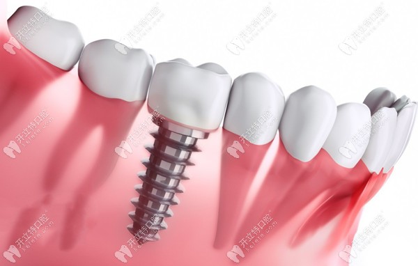 潍坊登腾种植牙_潍坊口腔医院_潍坊坊子韩国启口腔郑梓恒