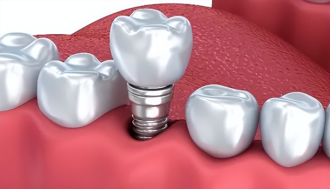 奔跑口腔诊所种植牙价格_荆州BEGO种植牙费用构成_德国BEGO种植牙荆州价格