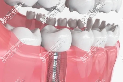 种植牙示意图